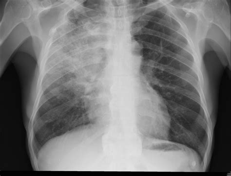 pulmão com pneumonia grave